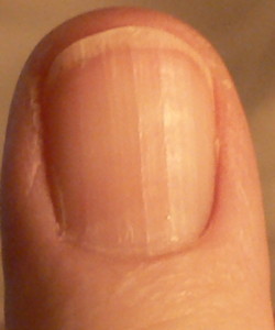 Nails Illness