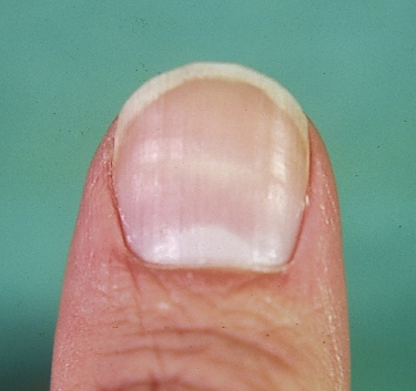 Transverse Nail Ridges: Horizontal lines may be a marker of a past episode