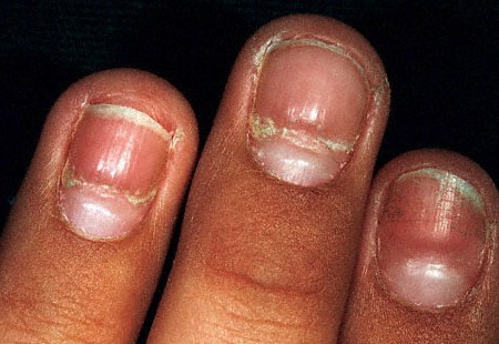 What causes nails to crack and split? | Zocdoc Answers